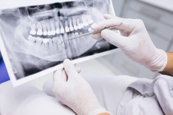 Cuándo es necesaria una extracción dental