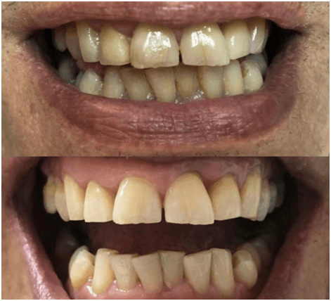 Tabaco y su impacto en nuestras encías y dientes 1