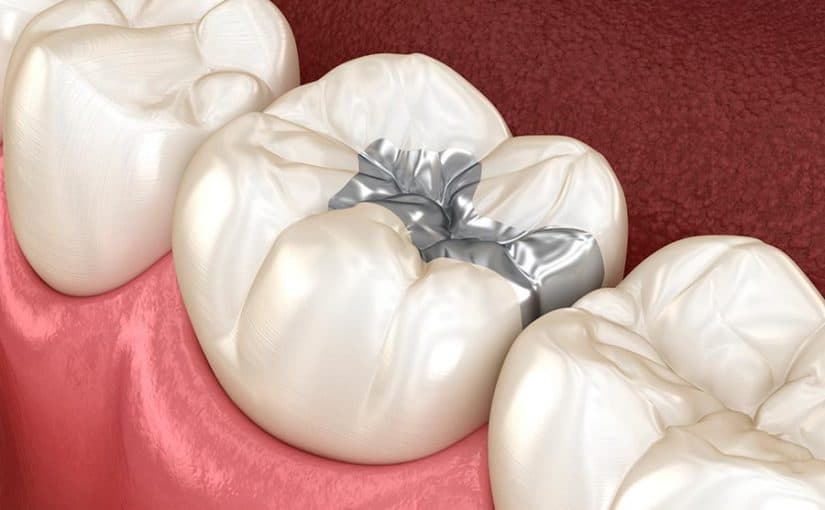 Que es la amalgama y de que esta compuesta