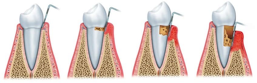 Periodontitis 2